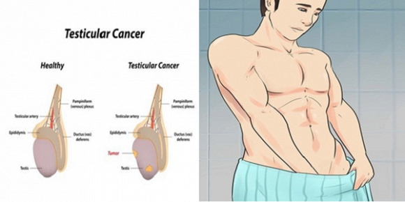 Ảnh 4 của Cancer of the testicles